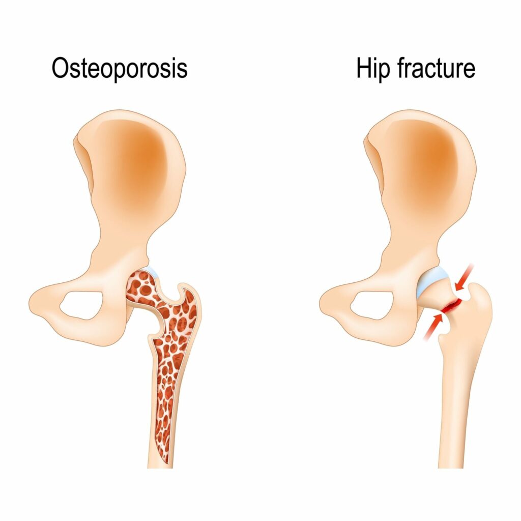 Hip fracture from osteoporosis: diagram comparing a thin hip bone with a fractured hip