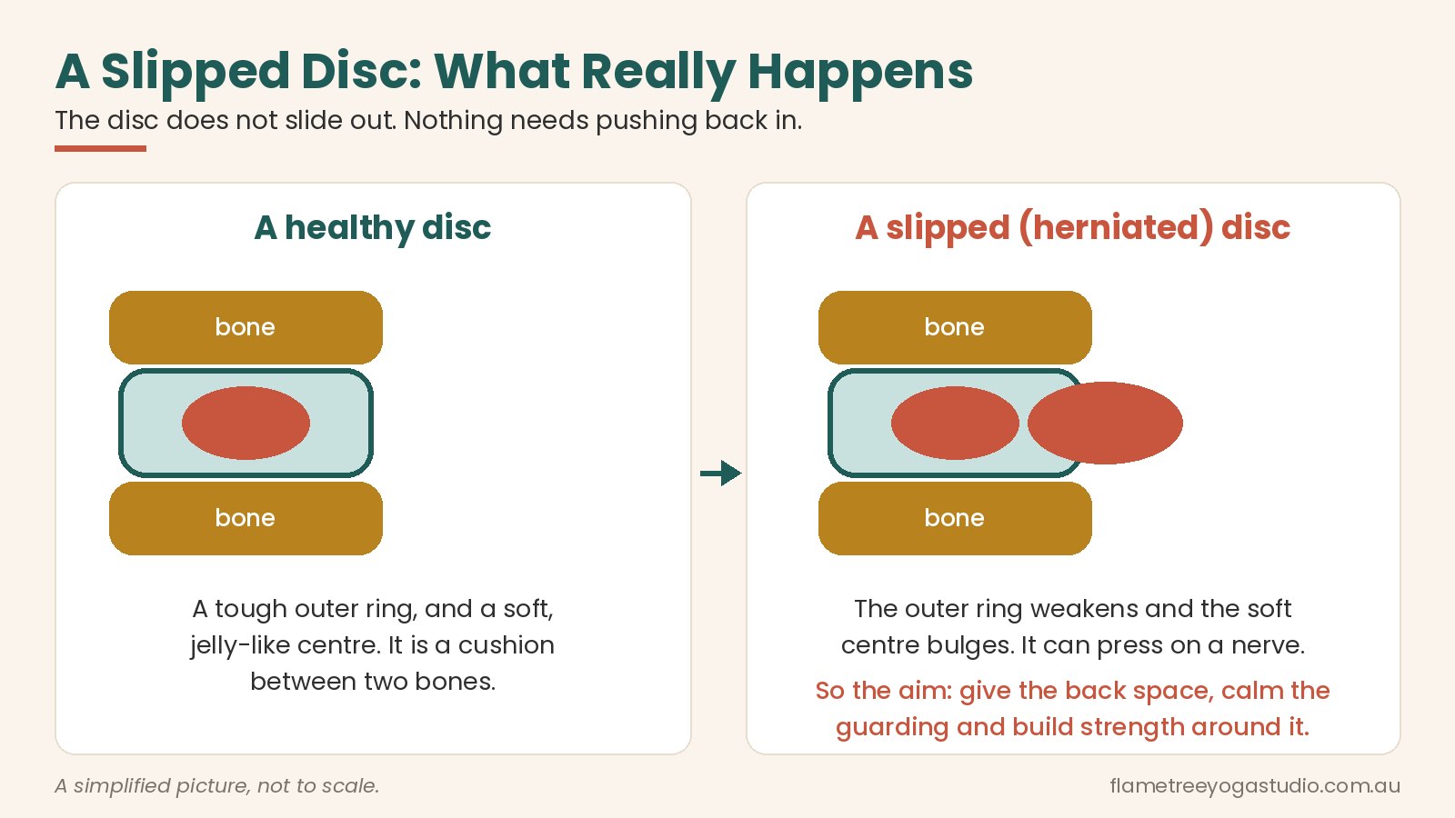 Slipped disc diagram: what really happens when a disc bulges, and why nothing slips out